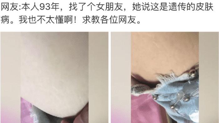 长江|“找了个日本老婆，她说这是天生的皮肤病！”遗传的天生丽质吗