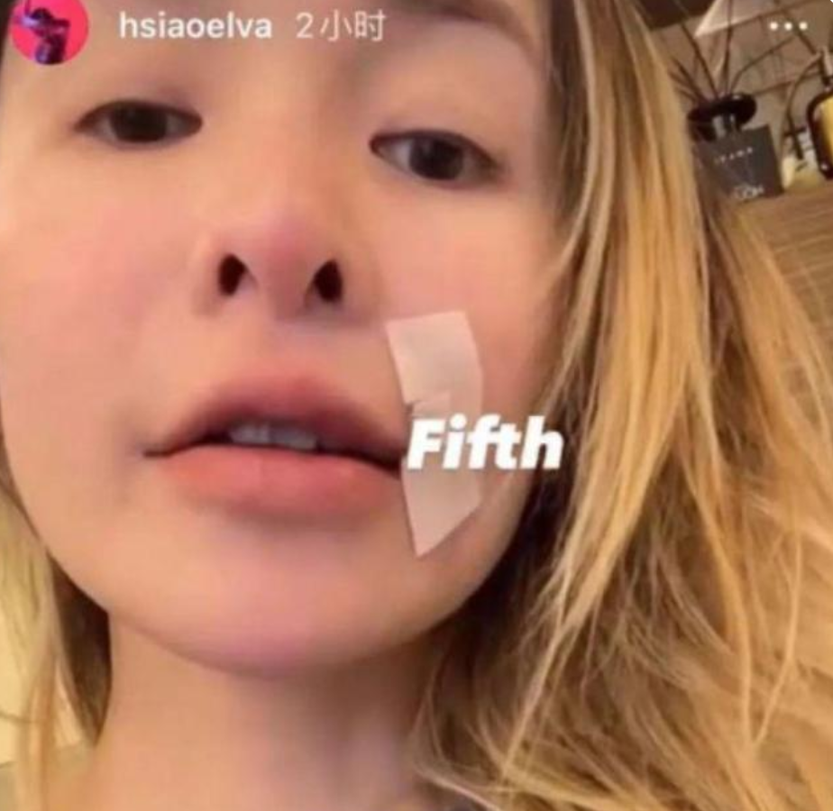 萧亚轩|真毁容了?42岁萧亚轩罕见晒怼脸自拍,疤痕明显超大超深一条