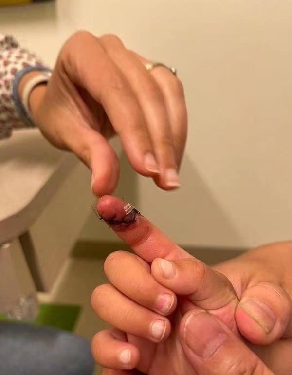 郑星源|张恒起诉郑爽虐待女儿，爆出孩子缝针伤口，伤口有6厘米