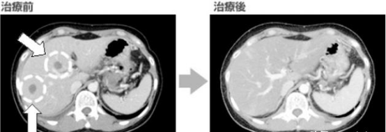 肿瘤消失,生存期翻倍,NK细胞效果惊人