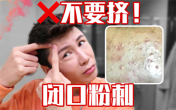 洗面奶 去粉刺用什么产品好？快速有效去粉刺产品排行榜