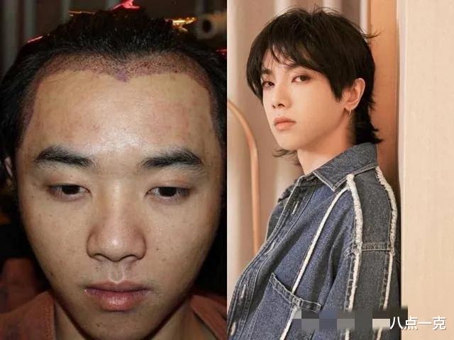 明星|高鼻梁、尖下巴，这些男明星看似逆天改命，实则后遗症很明显