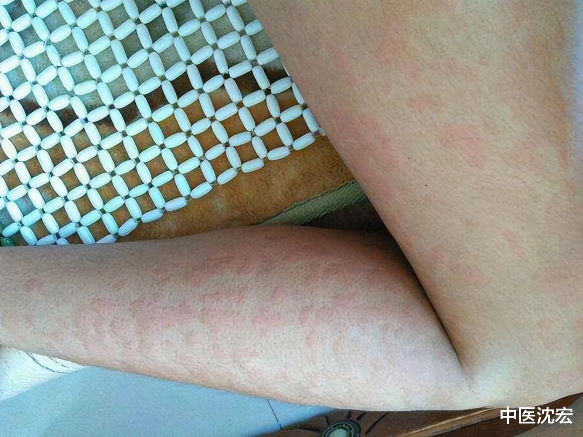 过敏|5味中药 对过敏湿疹，荨麻疹、皮肤瘙痒、皮炎 妙不可言。