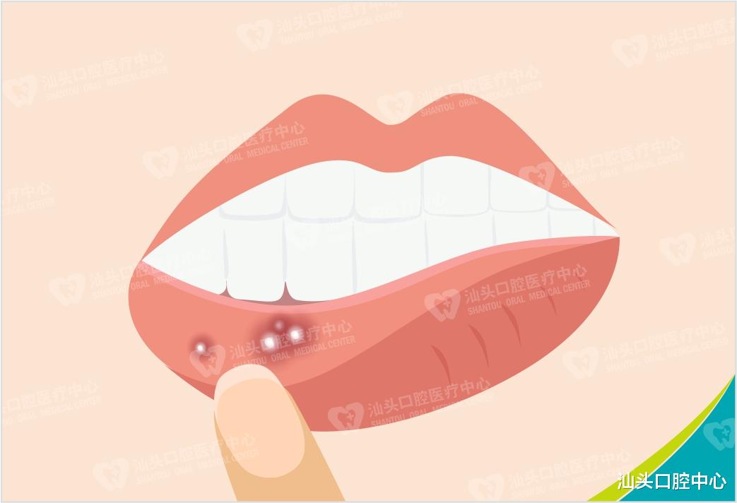 肾脏病|疼!口腔里反反复复地长溃疡,到底该怎么办?