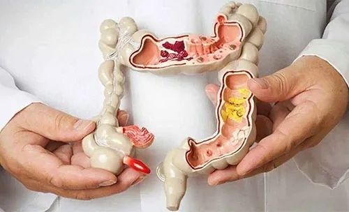 疾病|肠道健康的几个标准