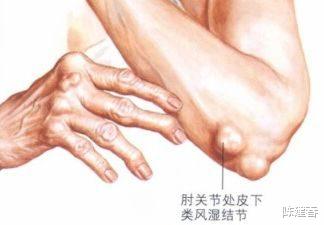 脾胃|类风湿结节与痛风结节有什么区别？如何区分？陈医生告诉你