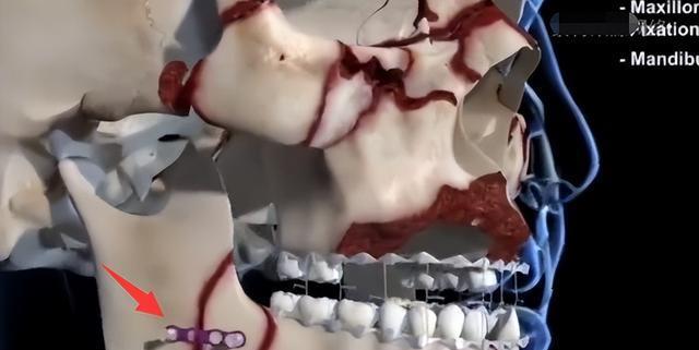 林志颖|这就是脸部3D重建?网友:看着都肉疼,林志颖得遭受多大的苦啊!