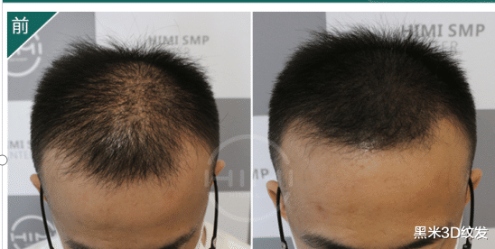 脱发|职场人如何预防脱发，不如先关注头皮健康！