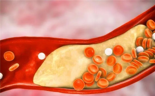 眩晕|胆固醇高了，身体会有四种表现，三个方法降脂，保护血管