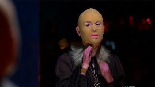 火山爆发中存活的女子：死里逃生，70%身体被烧伤，为生存而战