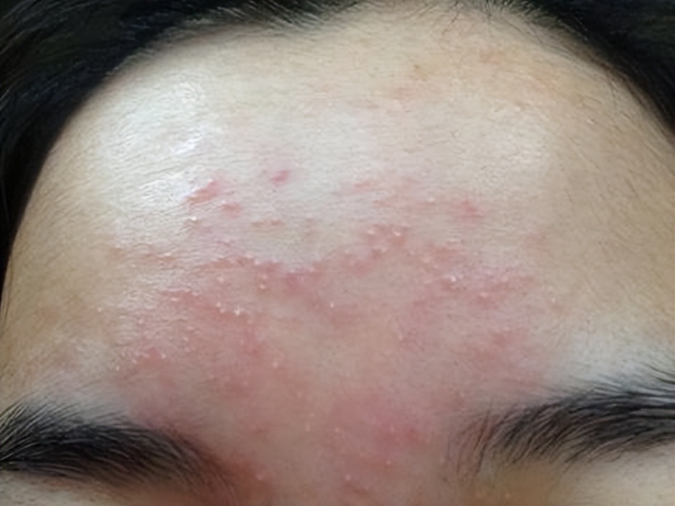 湿疹|药店里不起眼的牛黄上清片,不仅能清热解毒,还能治疗这5种病