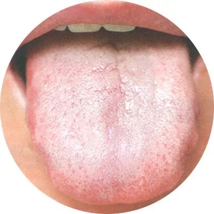 失眠|中医中的舌诊，了解吗