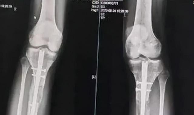 迪士尼|曾花16万断骨,只为长高7.2厘米的李亚诺,如今与后遗症为伴