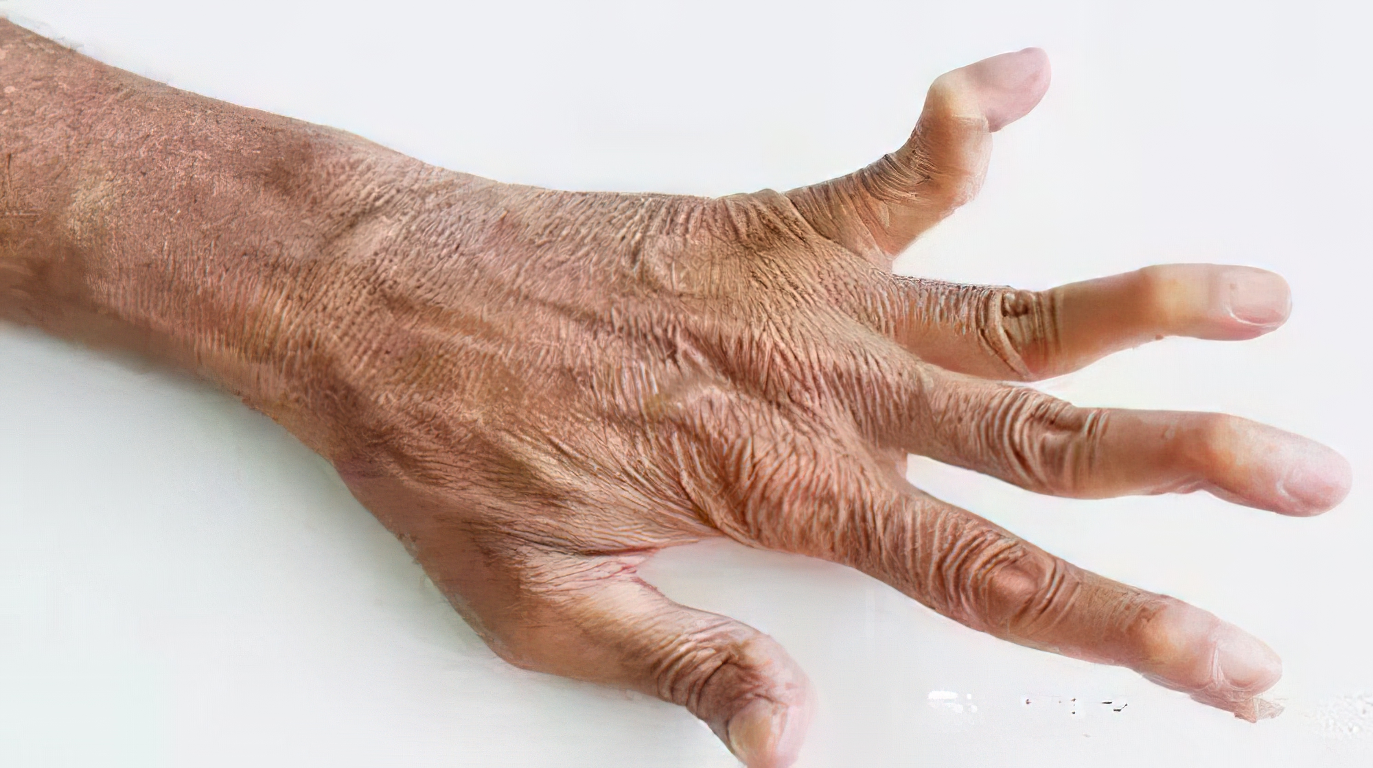 类风湿关节炎|得了类风湿性关节炎最后会怎么样？