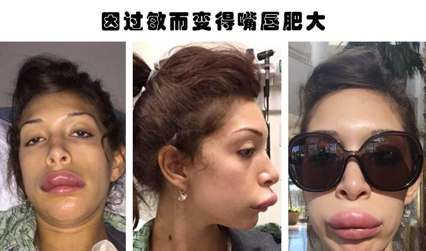 整容|整容失败的代价：据说因为整容而毁掉了自己容貌的6个人
