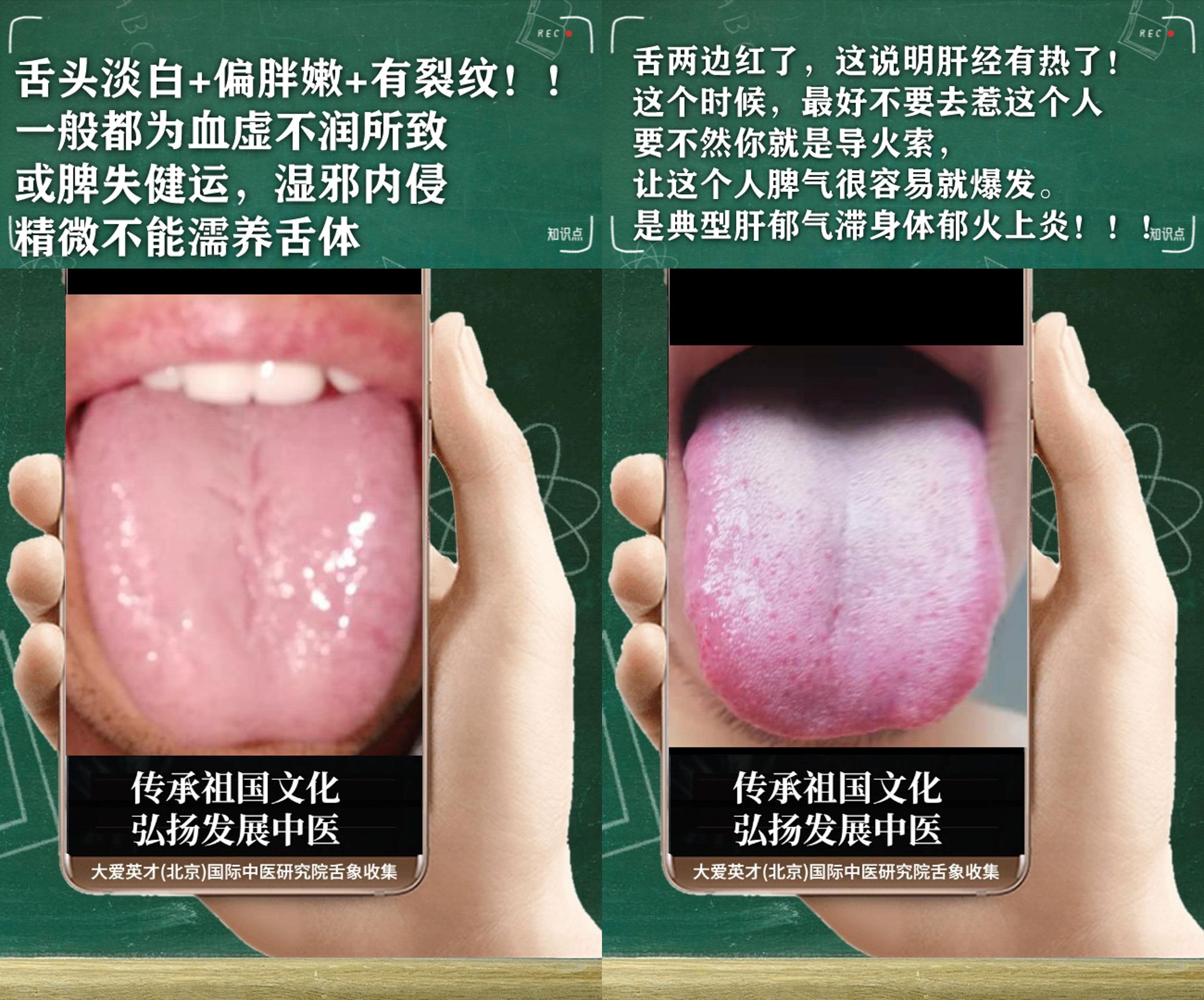 黄芪|中医病案：很抑欲，关节疼痛重，痰热互结，容易反复很不舒服