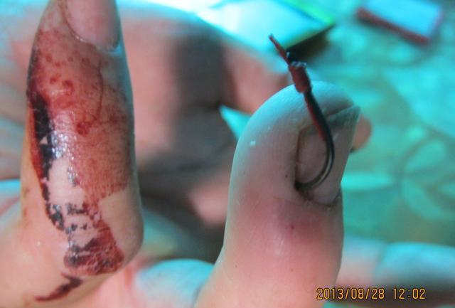 |盘点钓鱼人各种花式钓自己，看着就很疼！预防和处理方法分享