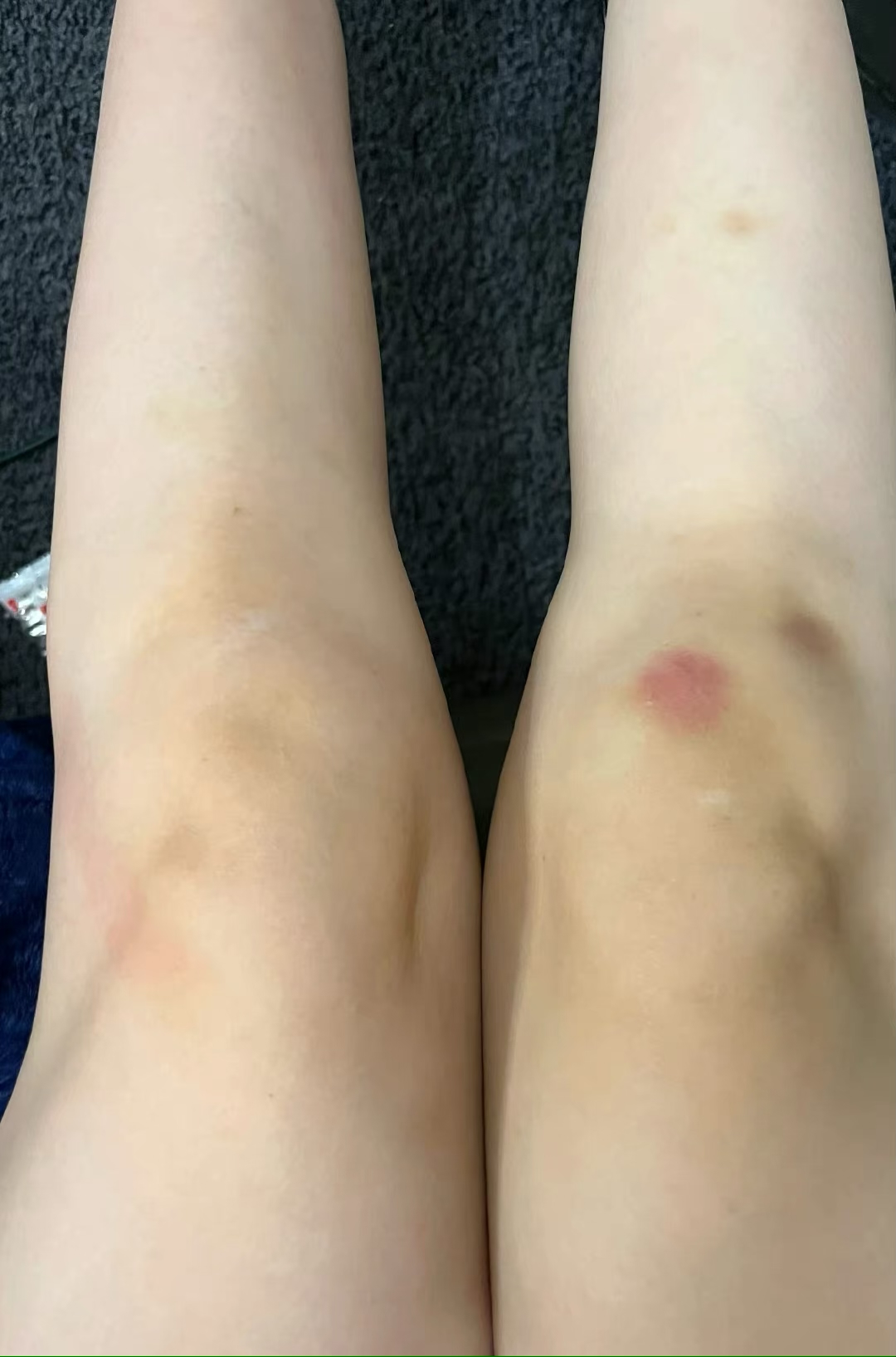 王灿|王灿一岁女儿好调皮，频繁跑步导致膝盖受伤，母亲晒照满是心疼