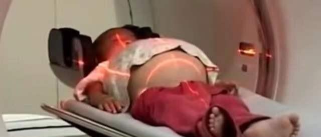 河南1岁半女童疑似怀孕,检查后在腹中发现胎儿,手术现场惊呆医生