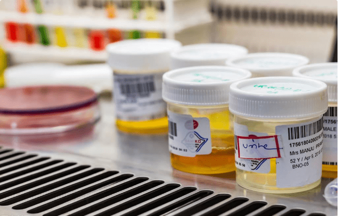 尿蛋白|不想长期尿蛋白导致肾衰竭,做好这5点维持长久稳定不难