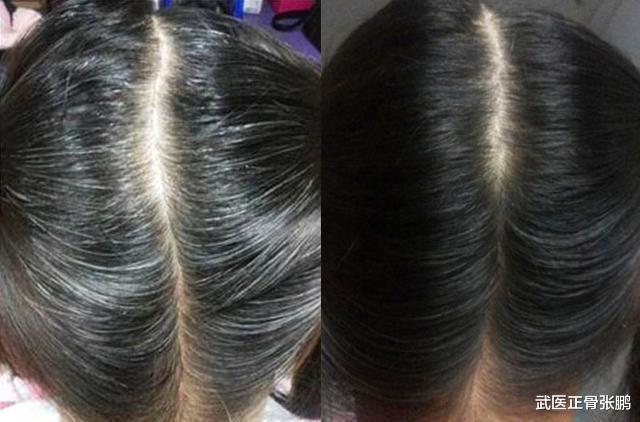 白发|年纪轻轻长白头发，只能染发吗？中医教你一招，补肝肾，找回乌发