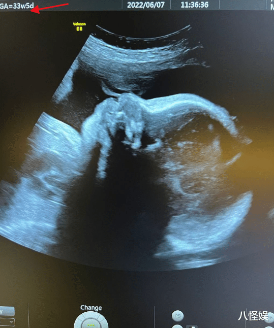 陈燃|陈燃预产期将至,晒B超照曝二胎是男孩,提前公布宝宝性别惹争议