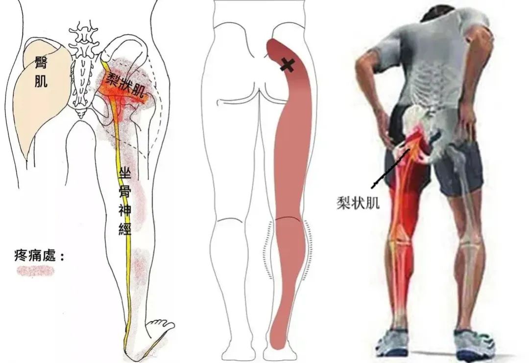 肝脏|臀部酸麻胀痛？你的梨状肌可能损伤了！这几个动作帮你摆脱苦恼！