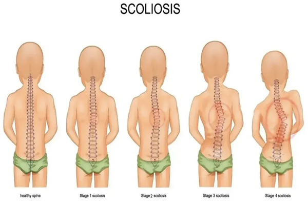 脊柱侧凸|10度以上的脊柱侧弯没治了吗?及时控制有可能恢复