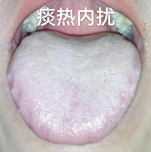 直肠癌|入睡难、易惊醒、噩梦多?分享六种中成药,帮你解决各种失眠问题