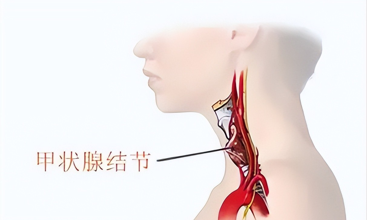 甲状腺结节|中医消除甲状腺结节——实例分享