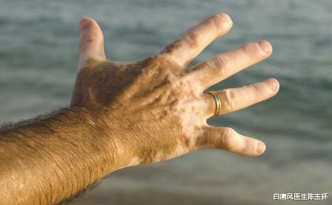 白癜风|为什么白癜风治好后皮损部位肤色较深？还会不会复发？