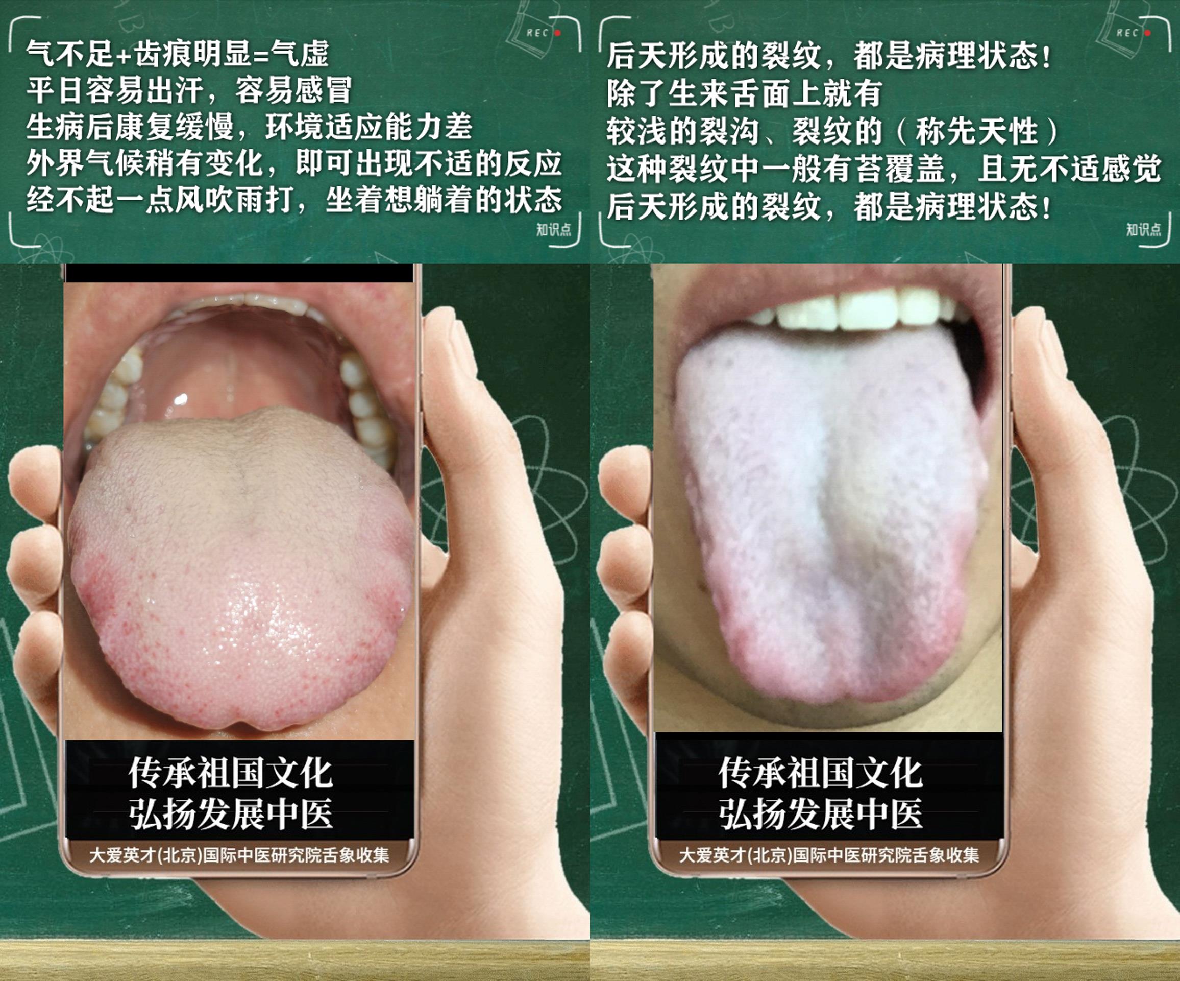 新型冠状病毒肺炎|中医解剖:容易出现口干口苦,大便干,脾虚气滞,一直反复很崩溃