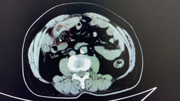 安神|一颗红枣下肚,老人痛失一段小肠