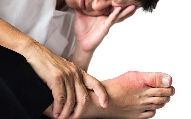 痛风|43岁男子半夜痛醒咬关节,妻子大哭道歉,可能“3件事”没控制住