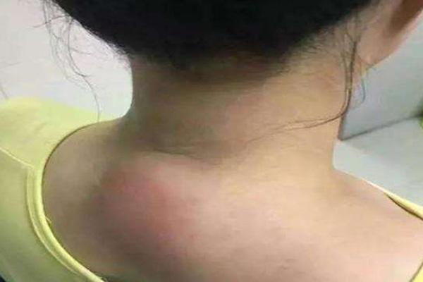 癌细胞|当脖子上“长”出了这3种东西时,有可能是癌细胞正在“苏醒”!