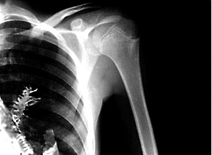 蛋白质|男子被查出肺癌，手术时医生在他肺里发现一棵树，肺真的能长树吗