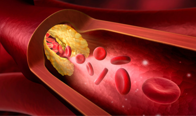 血栓|日本人很少得高血脂，他们有哪些好习惯，值得我们借鉴？早做了解