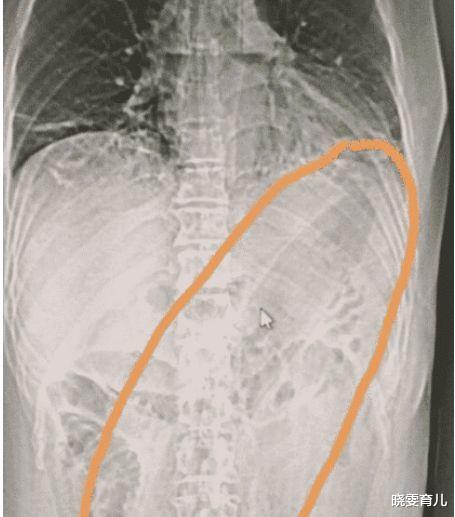 戒烟|突发悲剧!揪心!30厘米茄子快顶到心脏了,女子慌忙跑去医院就医,医生:怎么做到的?