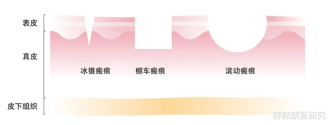 痤疮|痤疮瘢痕的康复治疗