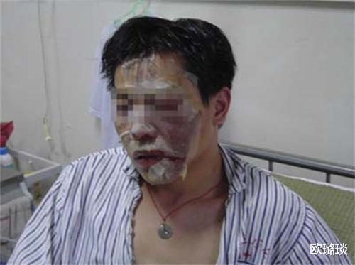 重庆19岁少年与女友分手后被泼硫酸,面部毁容,眼睛永远无法闭合