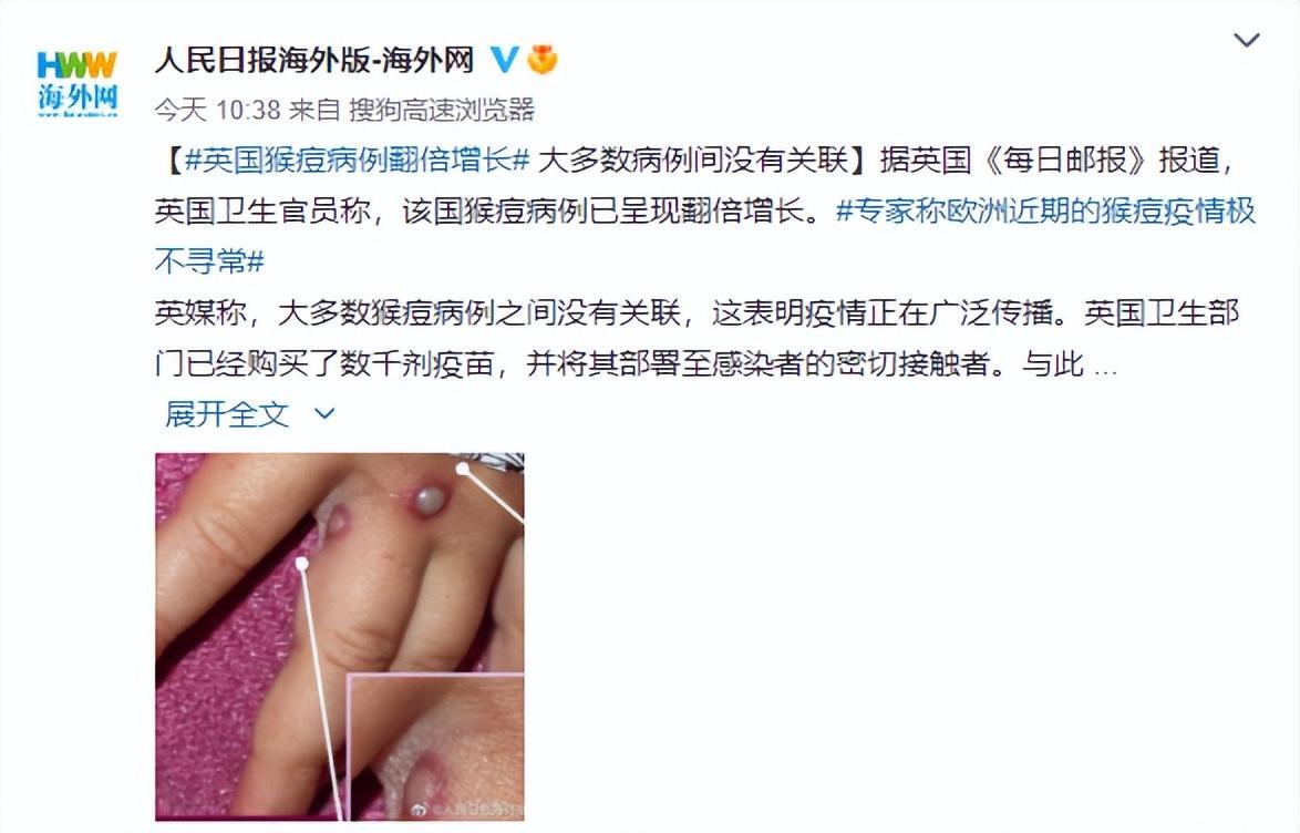 猴痘病毒是什么鬼?