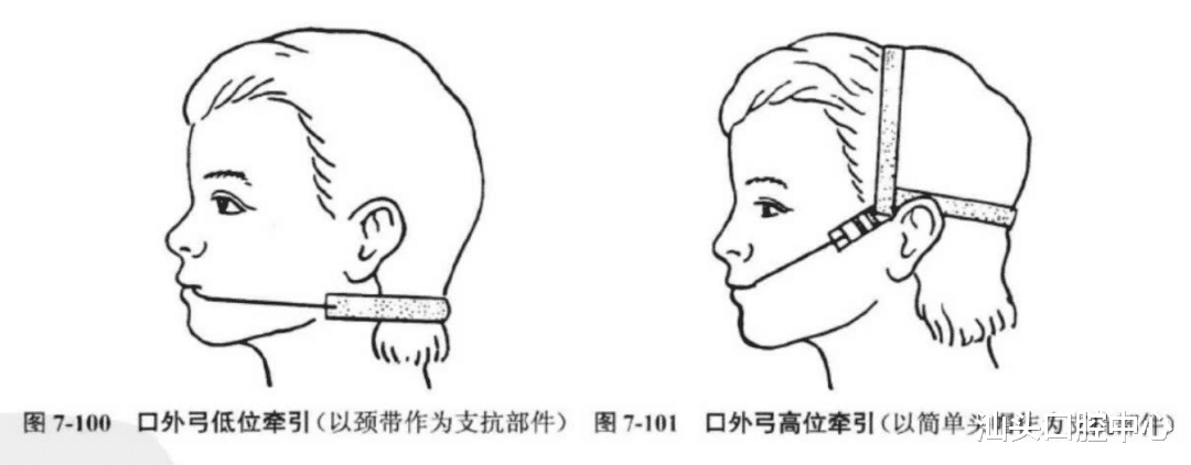 牙齿|推磨牙向后的病例,一定要选择隐形矫正吗?