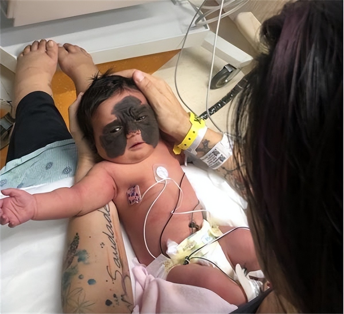 医生|还记得天生胎记酷似“蝙蝠侠”的女婴吗？6次整容后，仍在治疗
