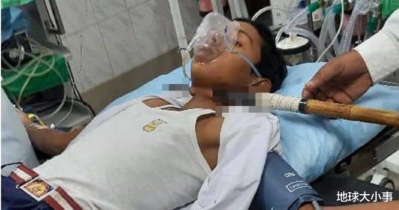 超命大!印度14岁少年遭「标枪刺穿脖子」,淡定坐等救护车送医