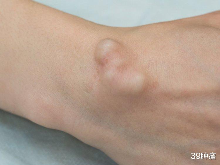恶性肿瘤|身上长肿瘤，不一定就是癌！若查出这4种瘤，恭喜你还算幸运