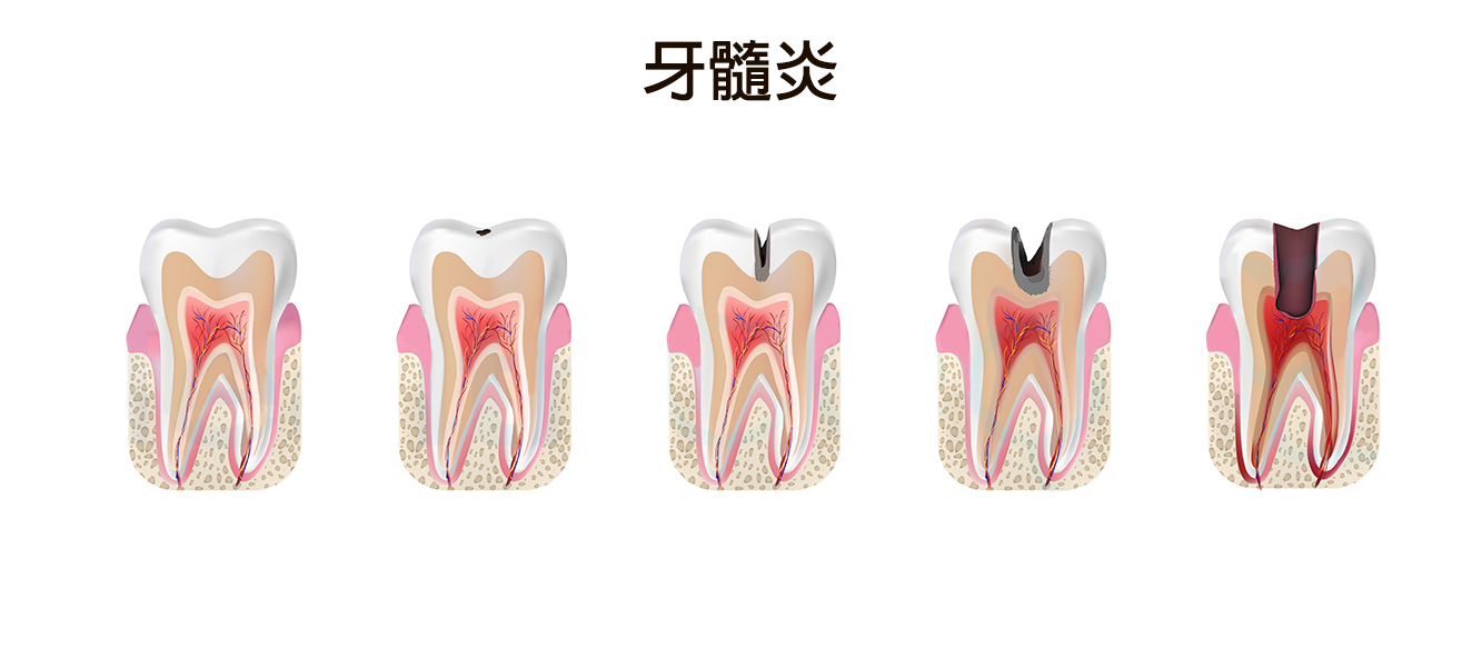 维生素B|【牙髓炎】小朋友蛀牙痛要注意了