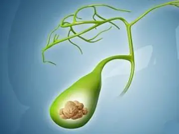 |胆结石怎么治疗才能更快排石？这个案例告诉你，不看拍大腿