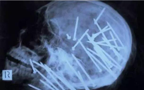 肺癌|盘点30张奇奇怪怪的X光片，看完整个人都不好了！