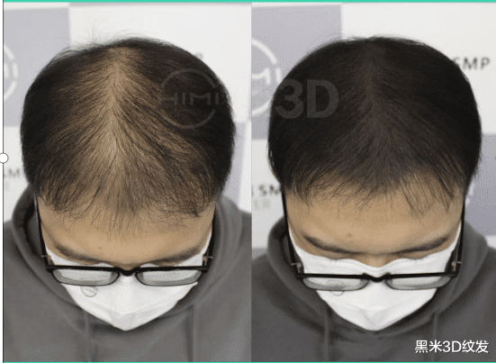 肠胃|脱发知识普及;脱发就表示毛囊坏死了吗?