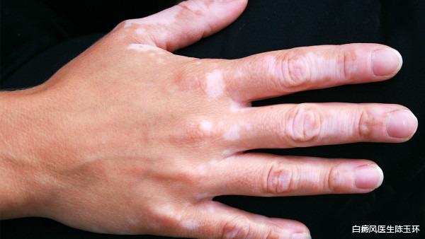 脑梗|白斑反复复发可能是因为只“治标”没“治本”